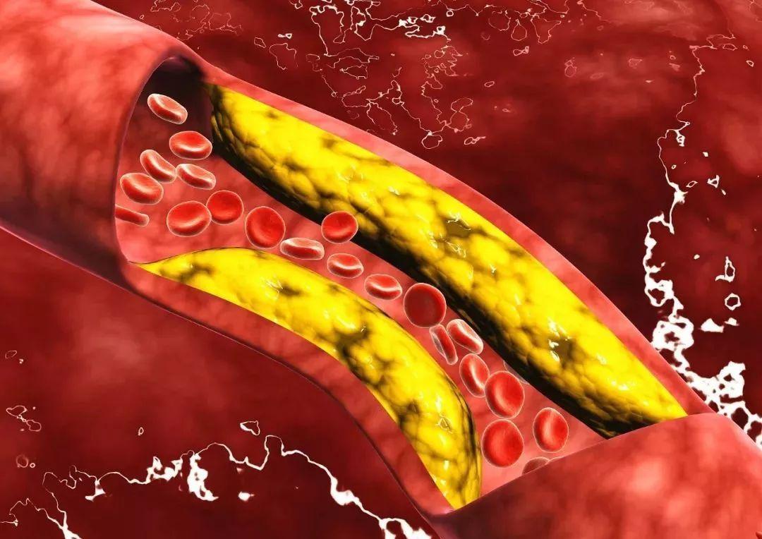 肾坏死是怎么得的,肾髓质坏死
