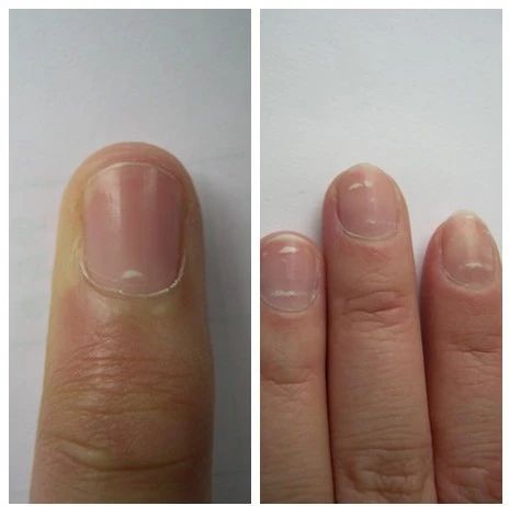 小小的指甲隐藏大大的健康秘密,小小指甲大调查