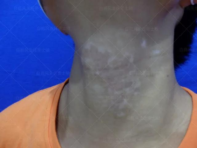 18岁男孩高考备战,18岁男孩白斑