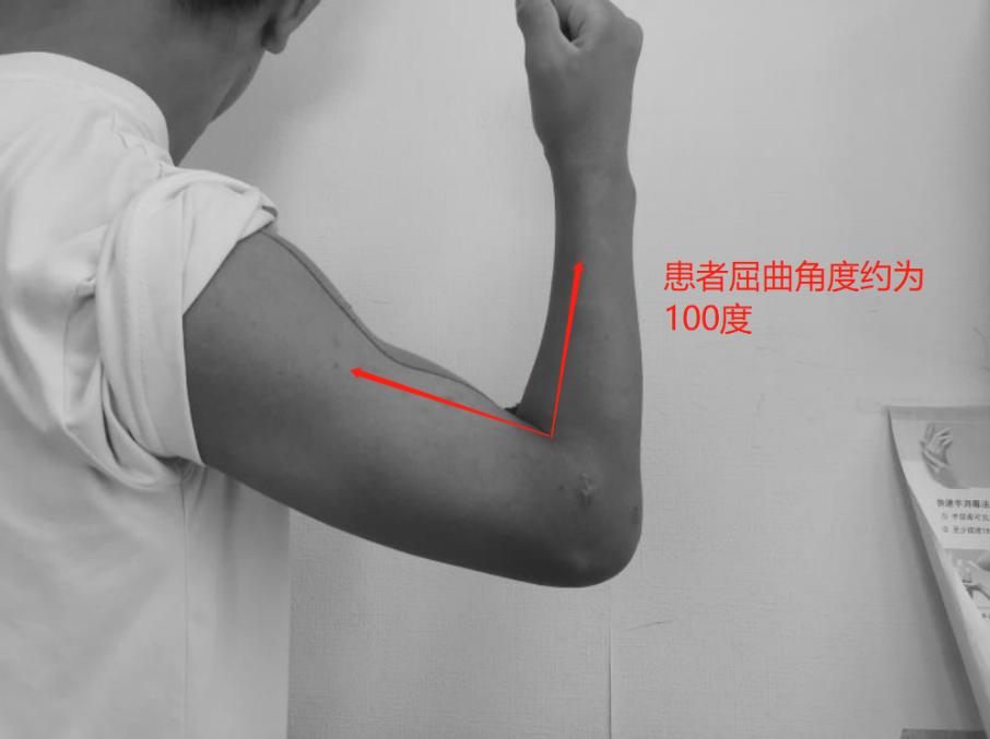 儿童胳膊肘手术后伸不直怎么恢复,手术后胳膊伸不直能恢复正常吗