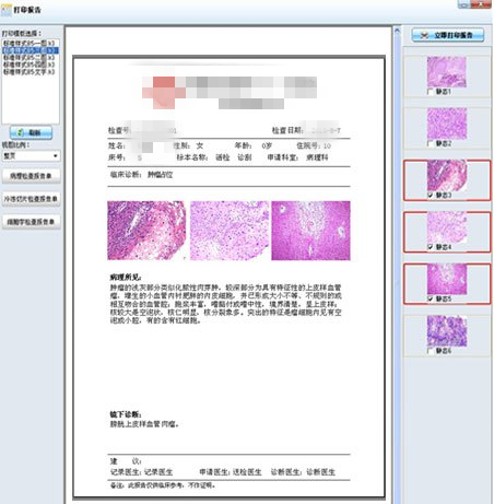 肿瘤病理报告怎么看,肿瘤怎样看病理报告