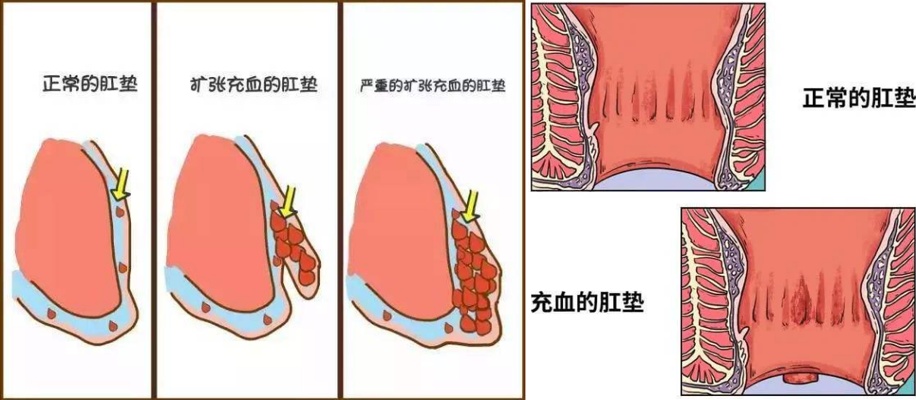 痔疮发展到什么程度了适合手术,痔疮目前国内最先进的手术