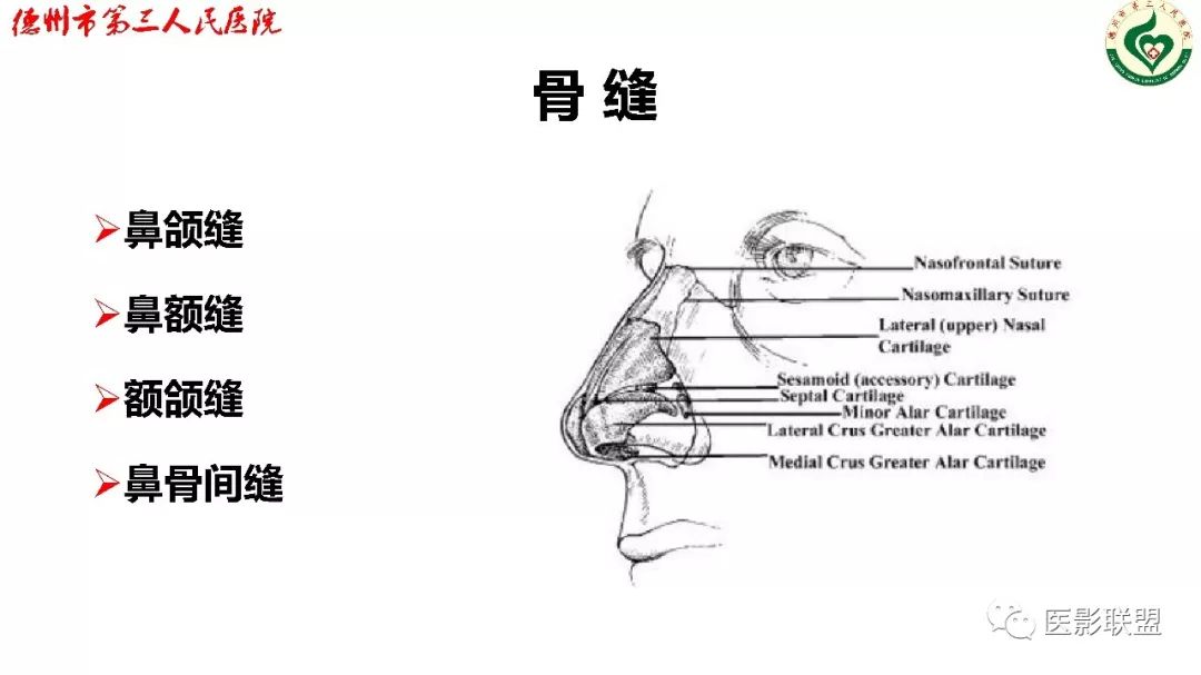 鼻骨骨折影像,鼻骨骨折dr影像表现