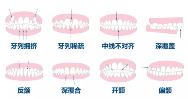 戴牙套为什么脸变丑了,心态崩溃是怎么回事