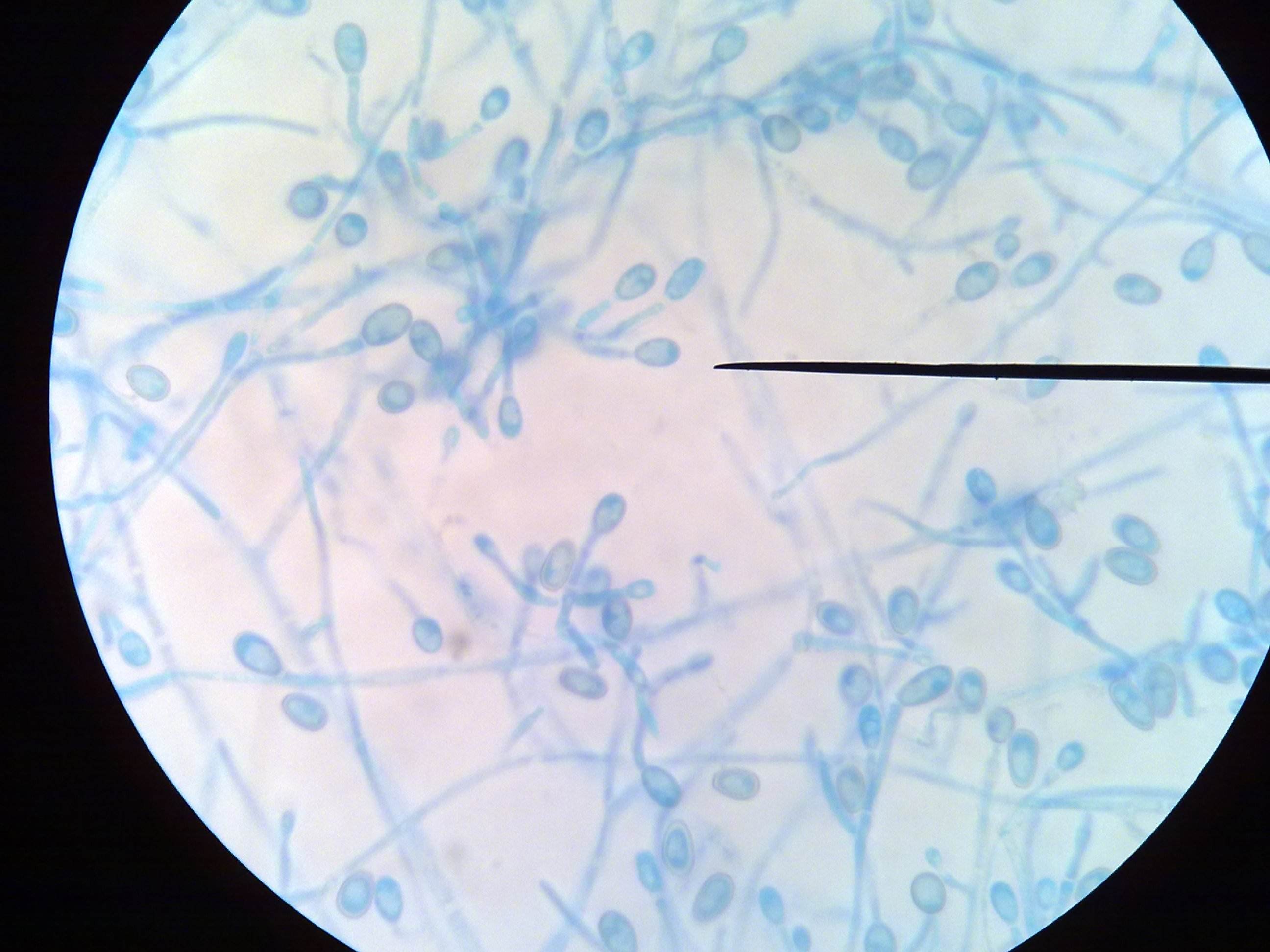 你对硬皮病了解多少,脚气和脚癣都是真菌吗
