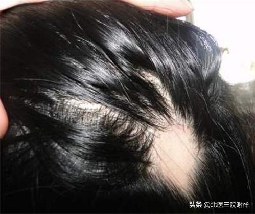 怎么分辨脱发的类型,脱发原因有几种类型