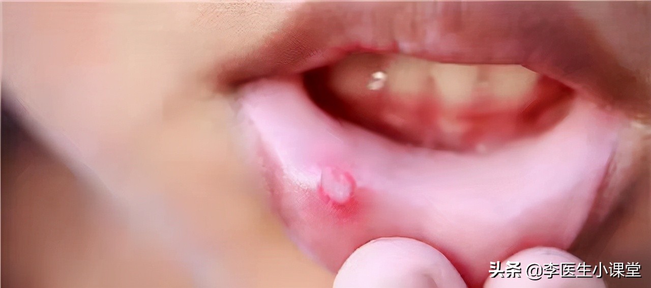 口腔溃疡用维c为什么好得快,有一种痛叫口腔溃疡