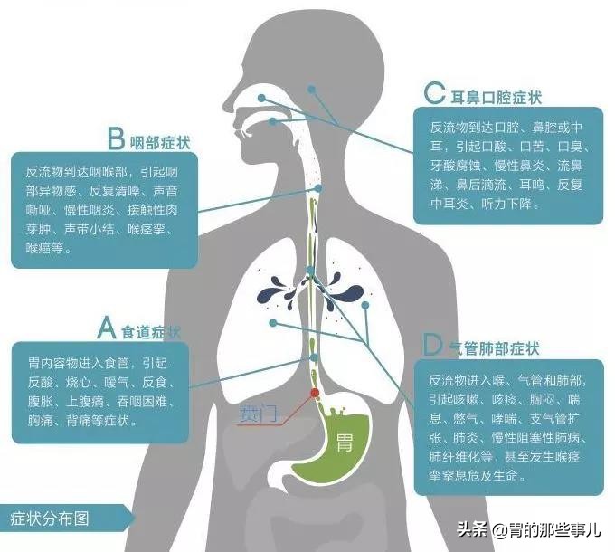 反流性咽喉炎怎么判断出来,反流性咽喉炎为什么感觉不到反酸