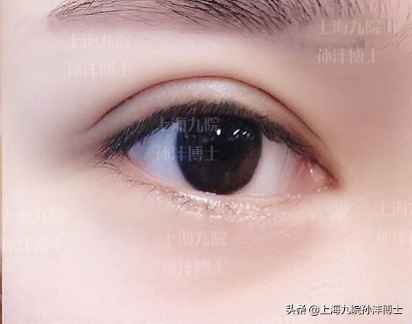 上海九院孙沣博士眼角修复,眼修复能找原来医生修复吗
