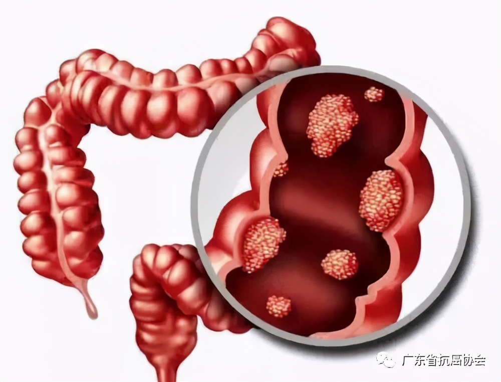 肠息肉距离肠癌有多远?