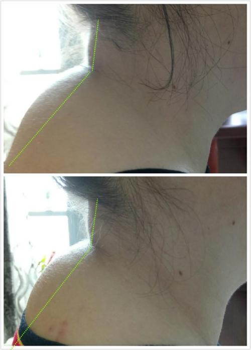 脖子后边的富贵包该怎么治疗,脖子后面的富贵包咋治呢