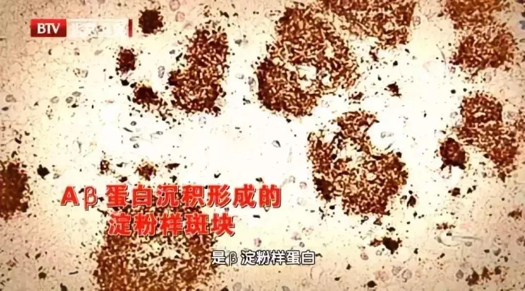 爱忘事是老年痴呆的前兆吗,延缓脑衰的10个方法