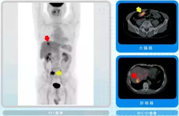 外国早期筛查癌症,petct用于诊断癌症