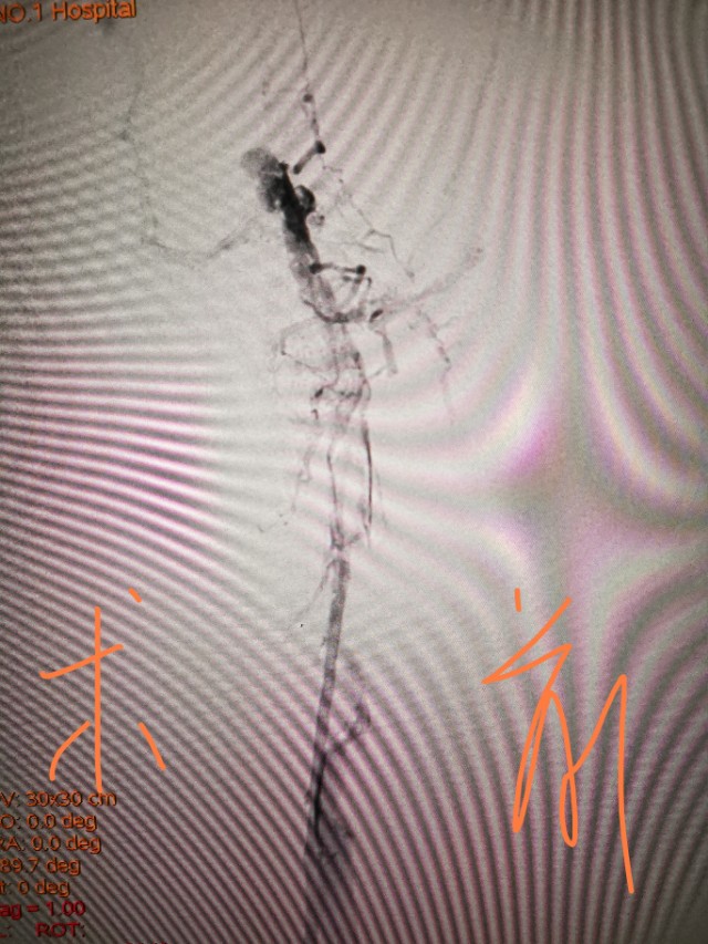 小腿发痒要警惕静脉曲张,小腿深静脉血栓的治疗方法是什么