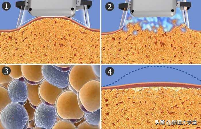 抽脂和吸脂后有什么注意事项,吸脂手术的危害和后遗症