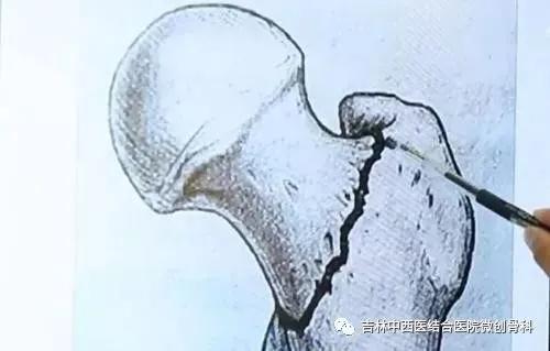 老人摔倒后髋部骨折的症状,老人摔倒髋部骨折卧床三年风险