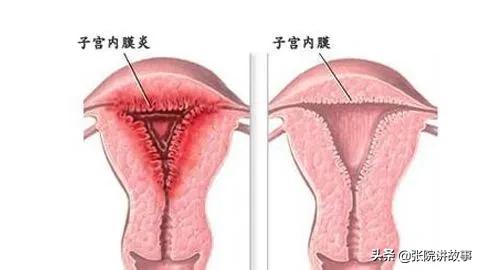 「张院讲故事」子宫内膜炎是如何导致女性不孕的?