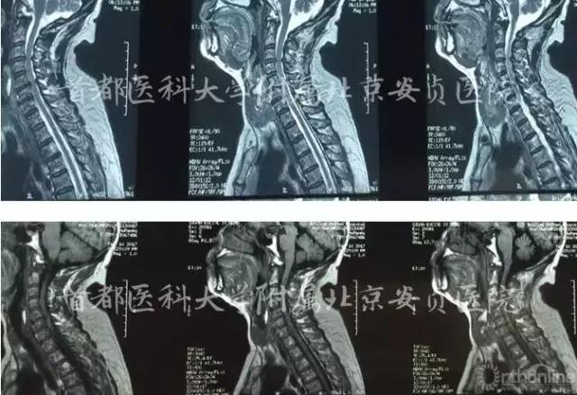 颈椎病引起的胸闷胸痛在哪个部位,颈椎病会引起咳嗽胸闷胸痛吗