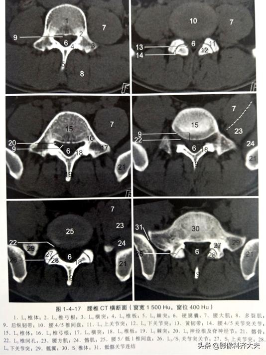 腰椎间盘突出的影像学诊断及治疗,腰椎间盘突出影像学课件