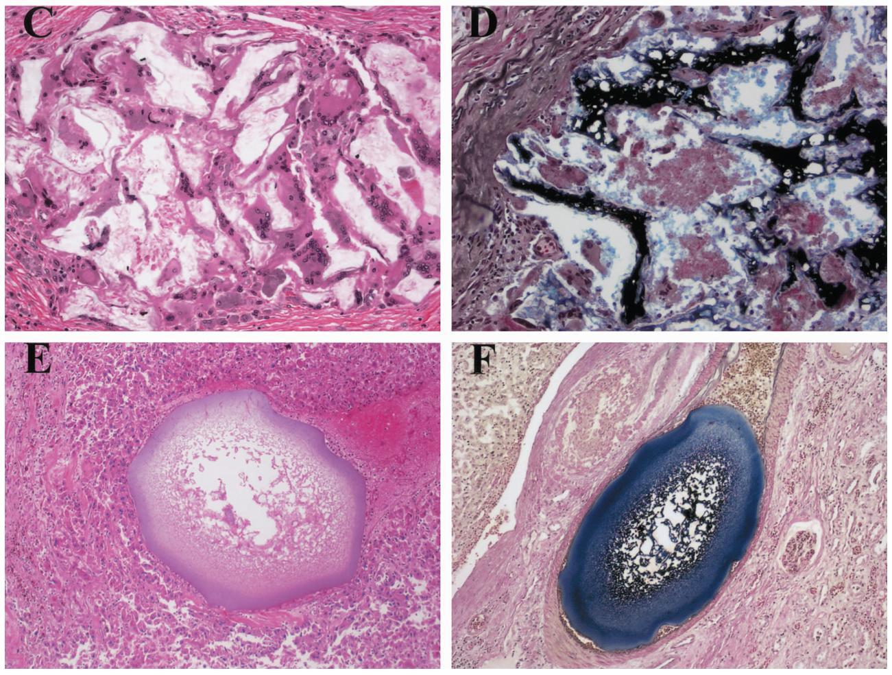 子宫肌瘤用介入栓塞会有后遗症吗,介入栓塞治疗子宫肌瘤多久消失