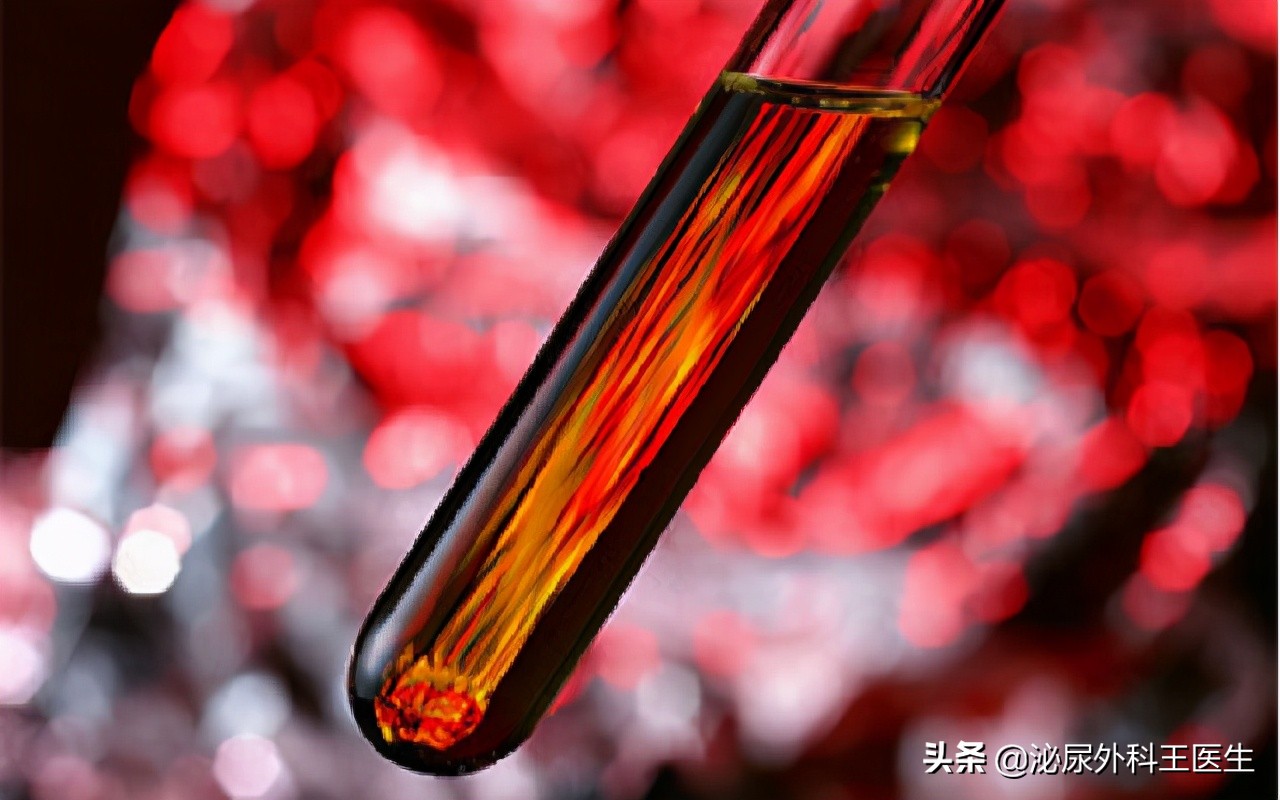 25岁小伙血肌酐1243住院治疗10天，肌酐下降到660，透析次数减少