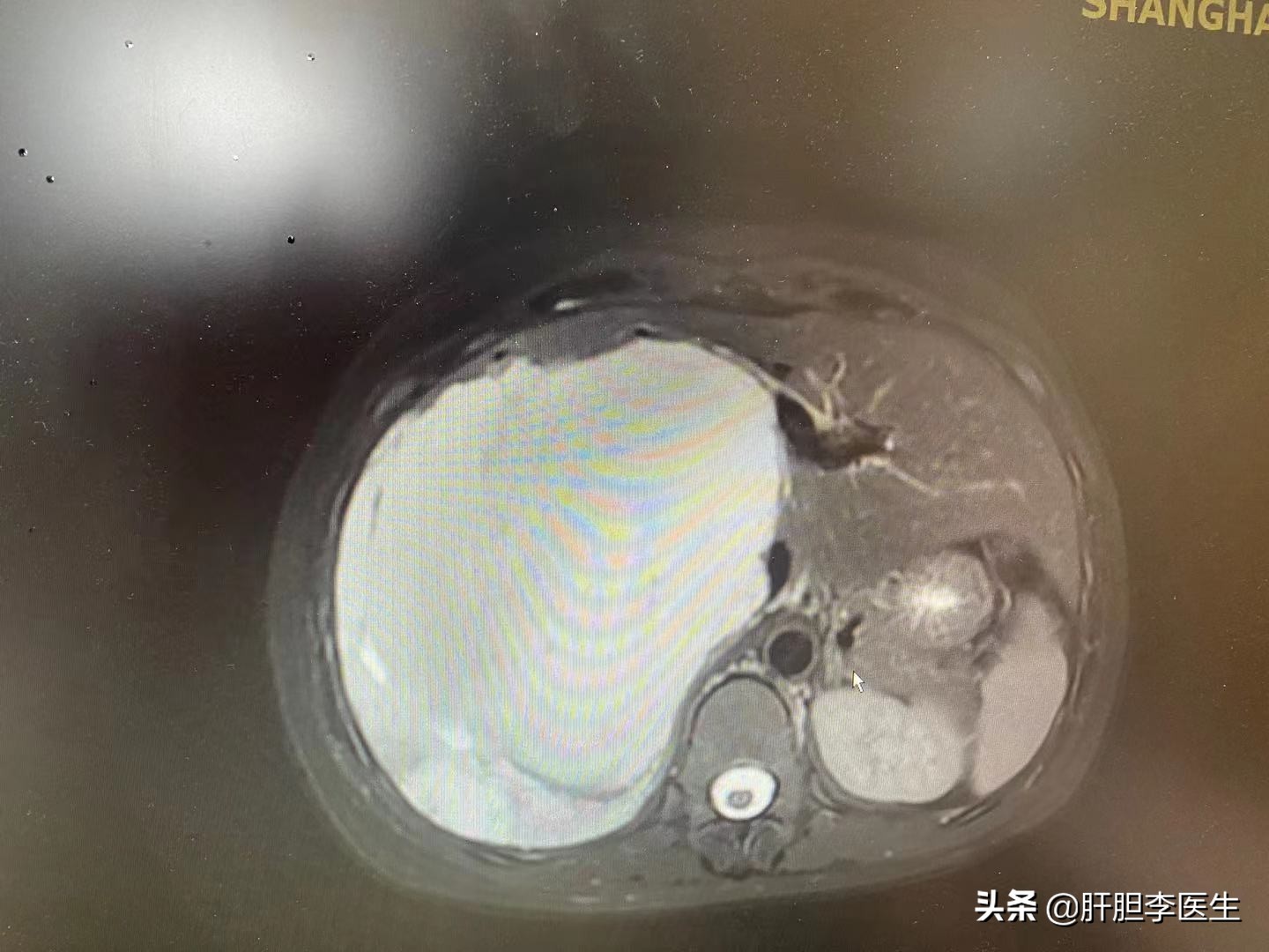 肝血管瘤3x2.5cm严重吗,体检发现肝血管瘤20*14mm