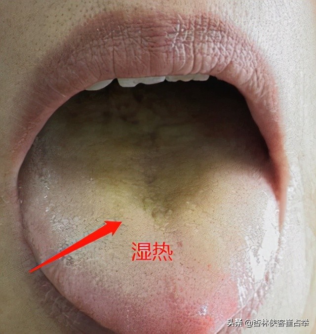 湿热长痘喝什么祛湿,体内湿热太重口苦口臭