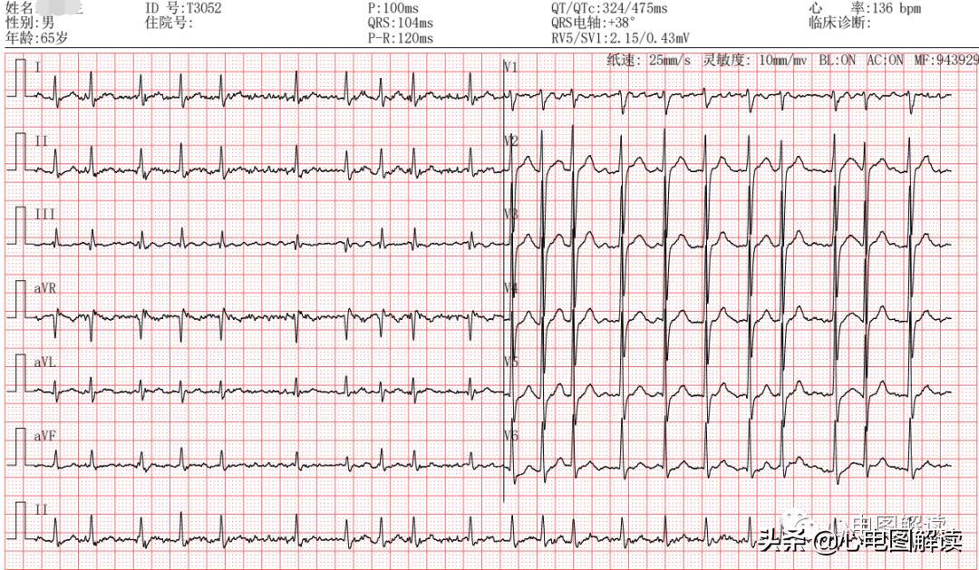 自医自治,最新心房颤动诊疗指南