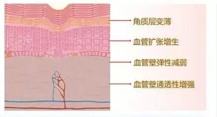 角质层薄容易过敏,角质层薄适合的水