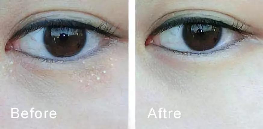 别再用针挑！用米澳拉，脂肪粒自己“掉”下来，效果胜过医美激光