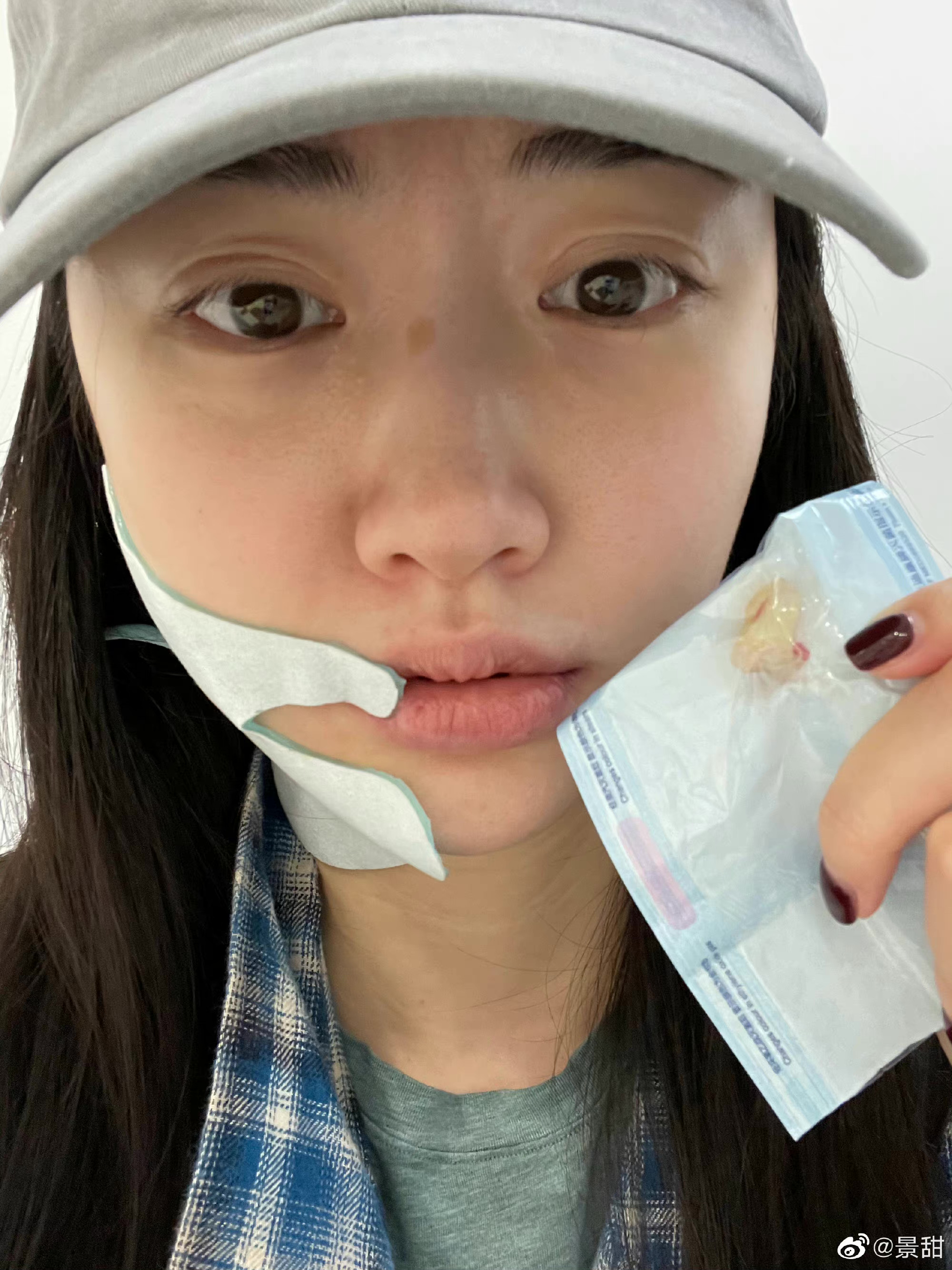景甜拔牙后自拍照,景甜拔牙后的自拍照