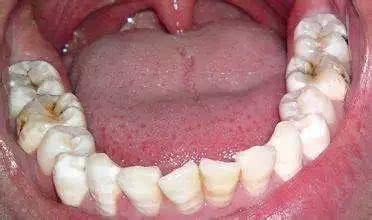 孩子得了牙龈炎怎么办,孩子牙龈炎怎么治疗最好