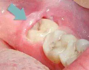 那些不拔智齿的人后来都怎么样了,那些该拔不拔的智齿最后都咋样了