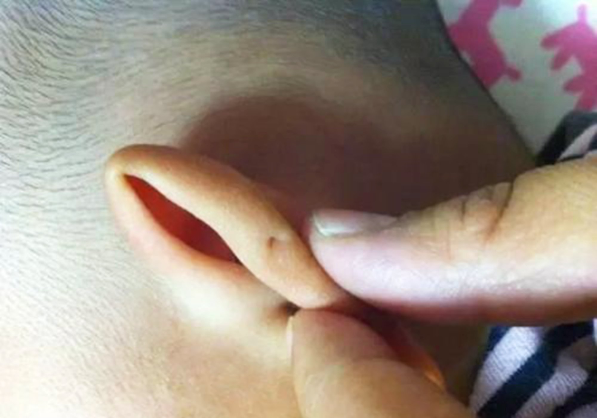 小孩一出生就有耳孔,宝宝有耳孔必须手术吗