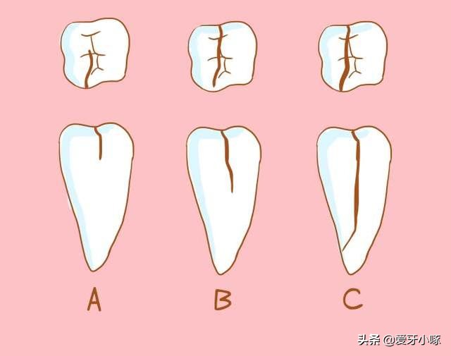 没有蛀牙就感觉有个洞,没有蛀牙但是隐约感觉有点牙疼