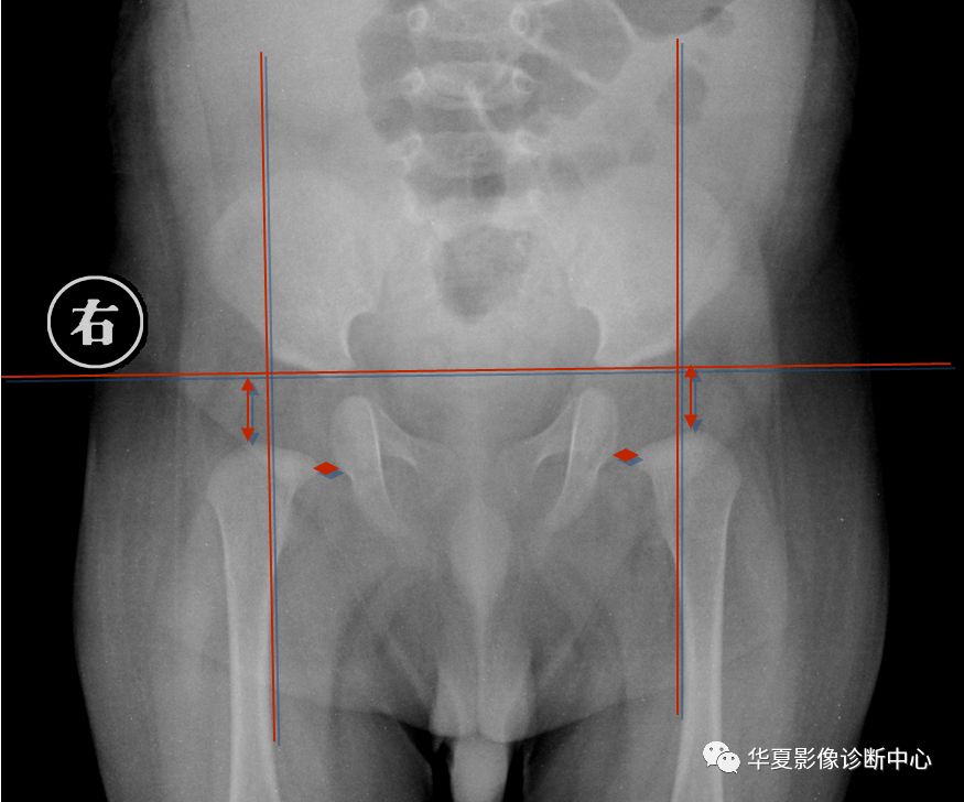 先天性髋关节脱位截骨术全过程,先天性髋关节脱位可以考驾驶证吗