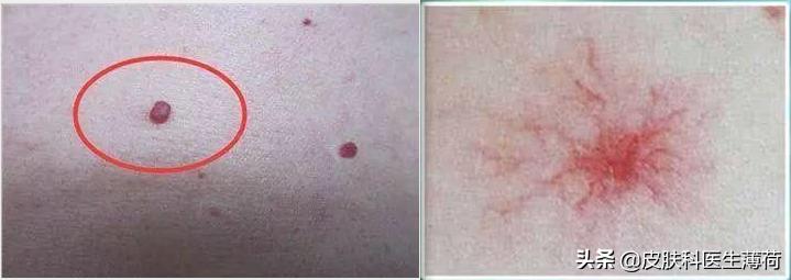 妊娠与皮肤|怀孕后爆痘、瘙痒、长斑，药膏、护肤品还能用吗？