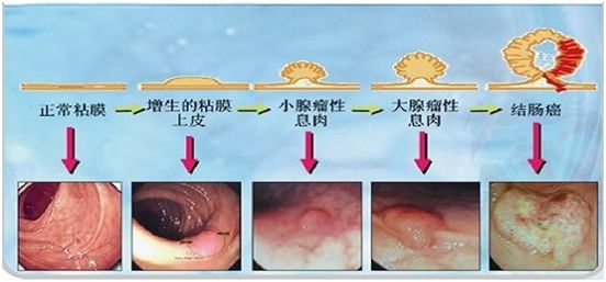 内镜下摘除息肉后几天能走路,内镜摘除肠胃息肉后饮食