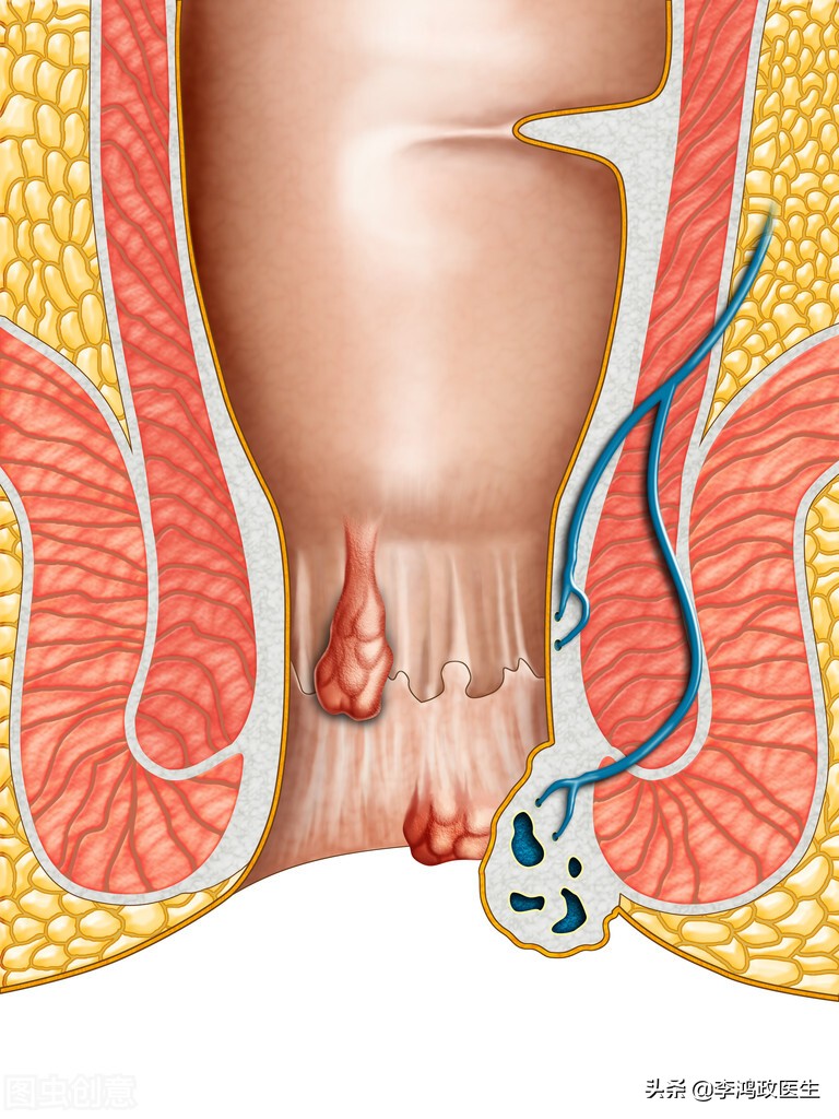 女性臀部反复长疙瘩,屁股肉疙瘩手术治疗全过程