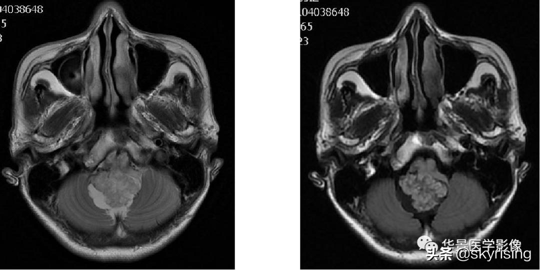 椎体侵袭性血管瘤mri影像学表现,中年妇女脑部血管海绵体瘤的症状