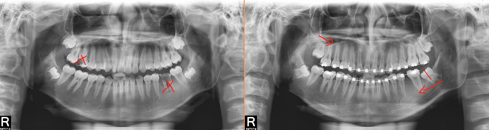 后磨牙可以矫正吗,第一磨牙龋坏可以用智齿补吗