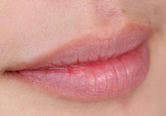 只有润唇膏如何迅速缓解嘴唇起皮,为什么每天涂唇膏都会起皮