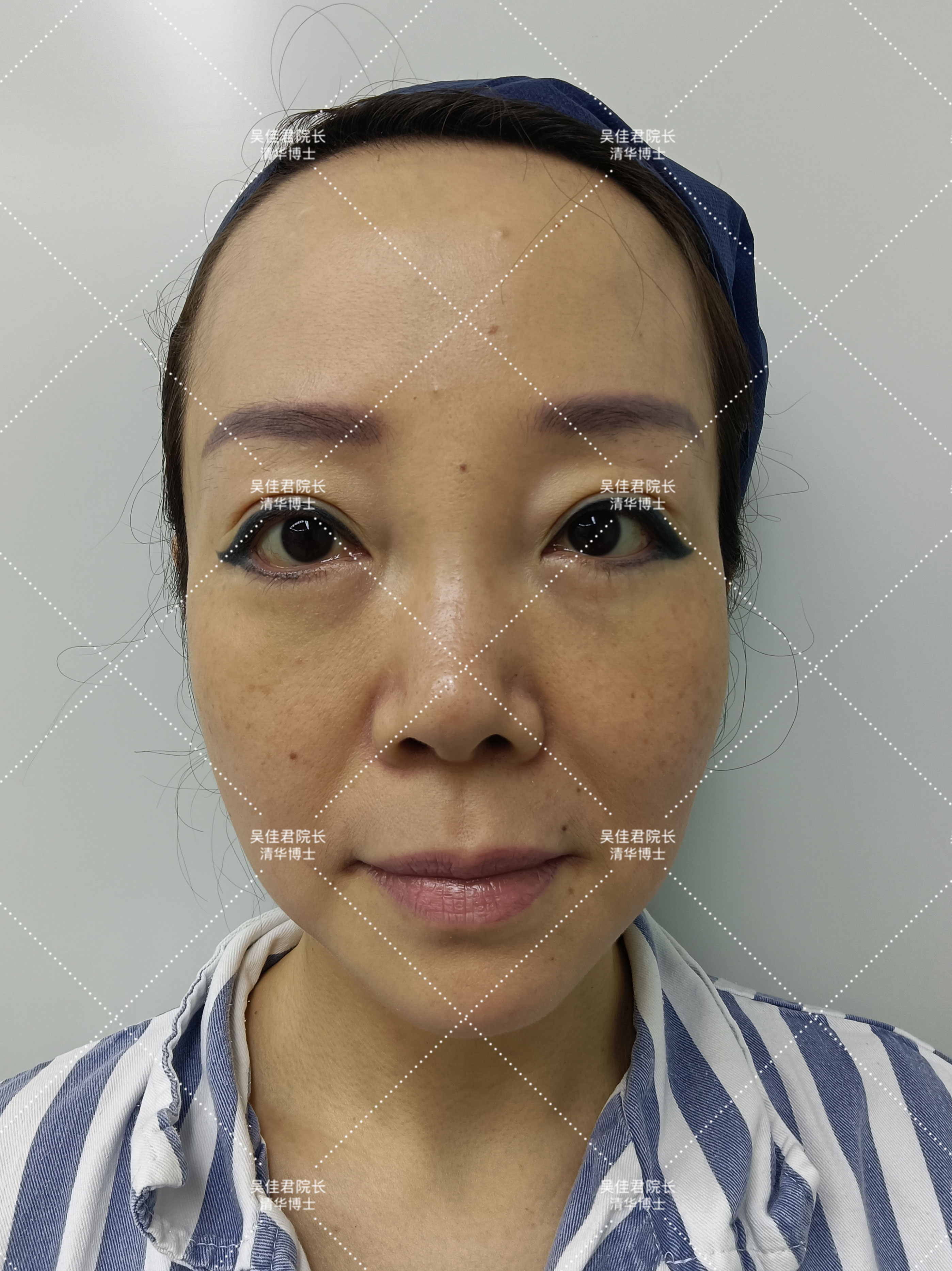 小切口拉皮除皱术适合额头除皱吗,额头缩小大拉皮手术恢复过程