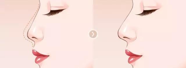 隆鼻能坚持到老吗,隆鼻的潜规则有哪些