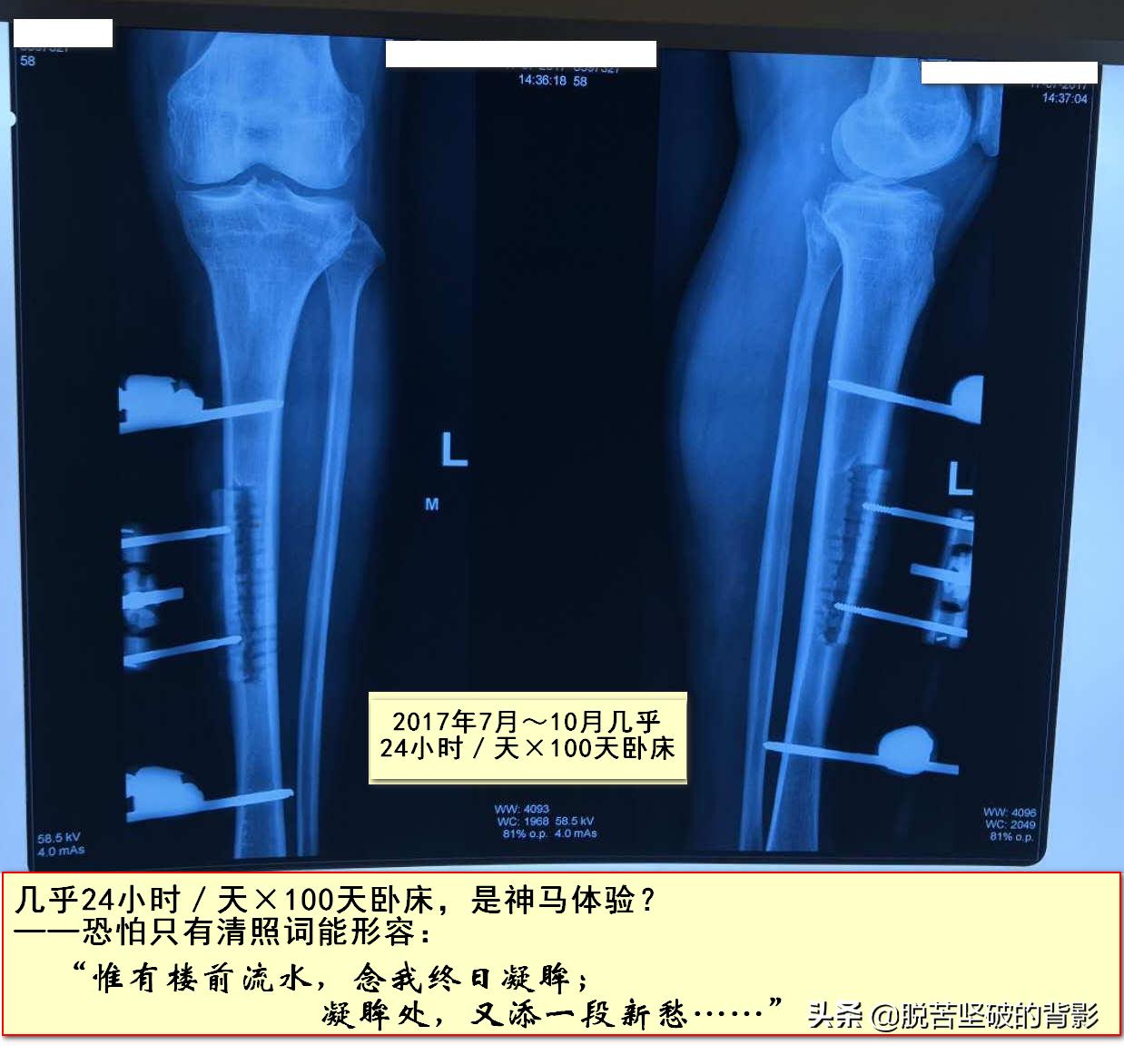 小小外伤4年8次住院，三甲医生举案说法：健康无小伤，手术须慎行