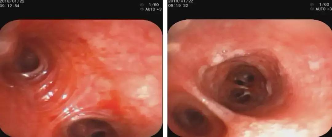 青年男性肺炎过后一直咳嗽怎么办,潜伏结核感染咳嗽咳痰