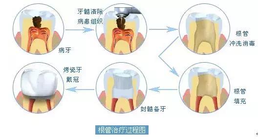 如何自己处理残根,怎样的残根可保留