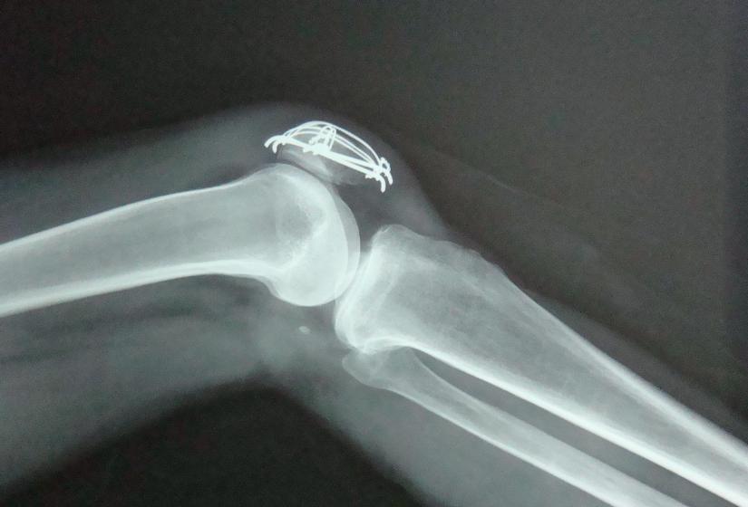 膝盖因积水而痛怎么治疗好得快,膝盖为何积水