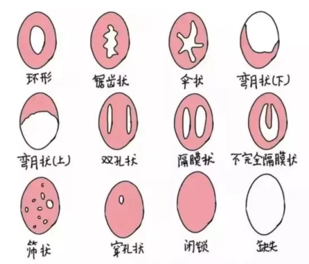 处女膜会影响妇科手术？这薄薄一层膜到底有何作用？太多人想错了