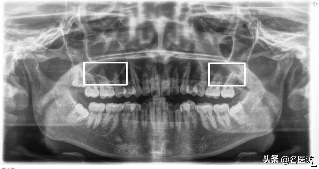矫正科普|美人在骨不在皮，从神秘的牙片看牙齿和侧貌颜值